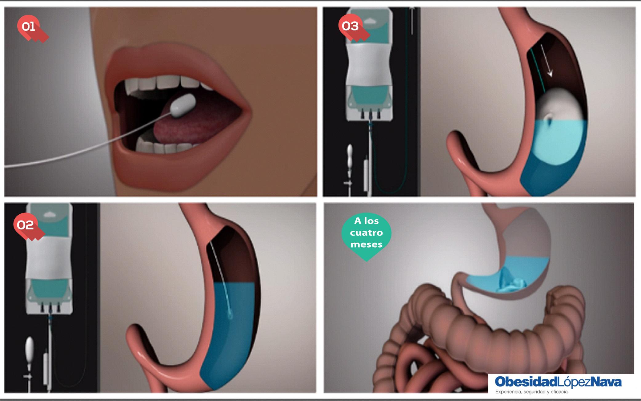 infografia autobalonsepte - Obesidad L&oacute;pez Nava