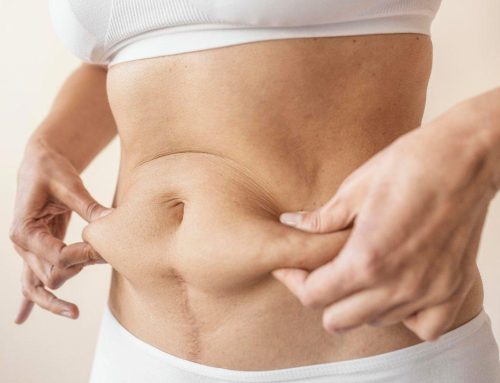 Balón intragástrico: una alternativa a la reducción de estómago