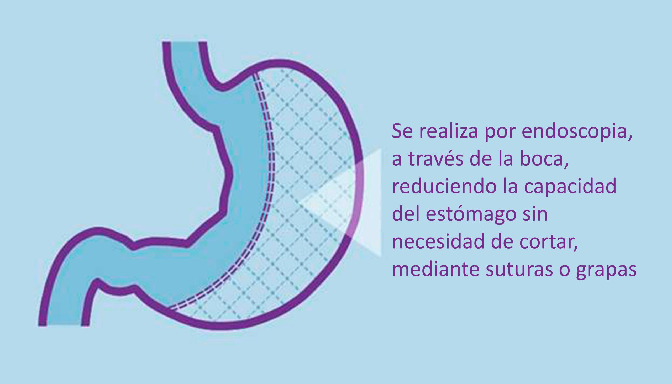 Info Reduccion de estomago por endoscopia junio 2019 scaled - Obesidad López Nava